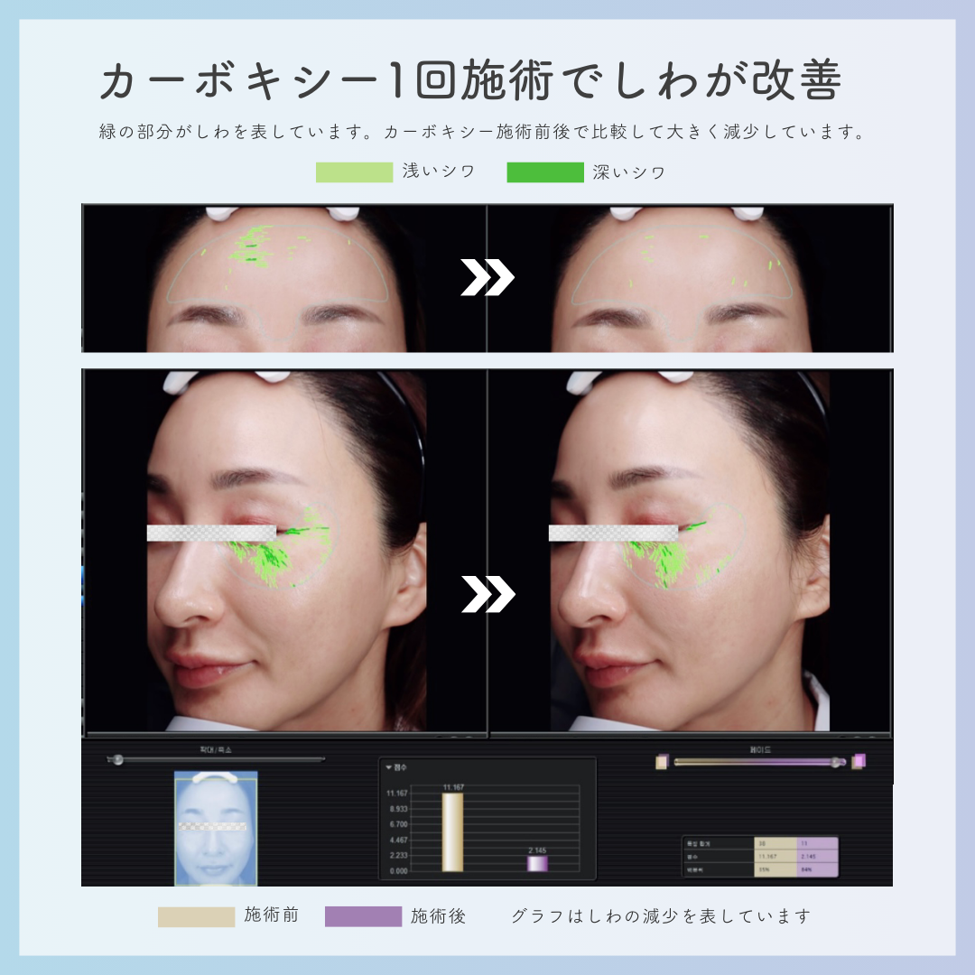 【RIBESKIN】カーボキシー炭酸パック(5回分)